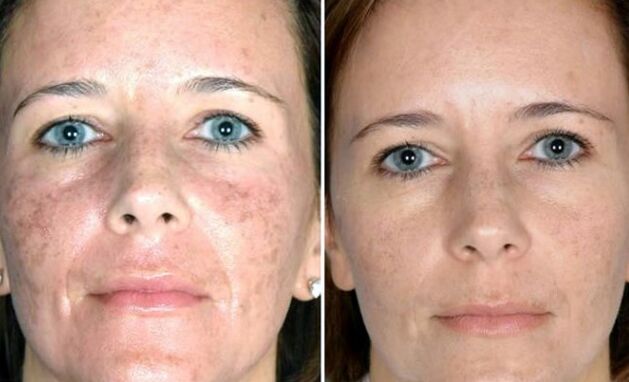 Field Laser Rejuvenation - Bago at Pagkatapos